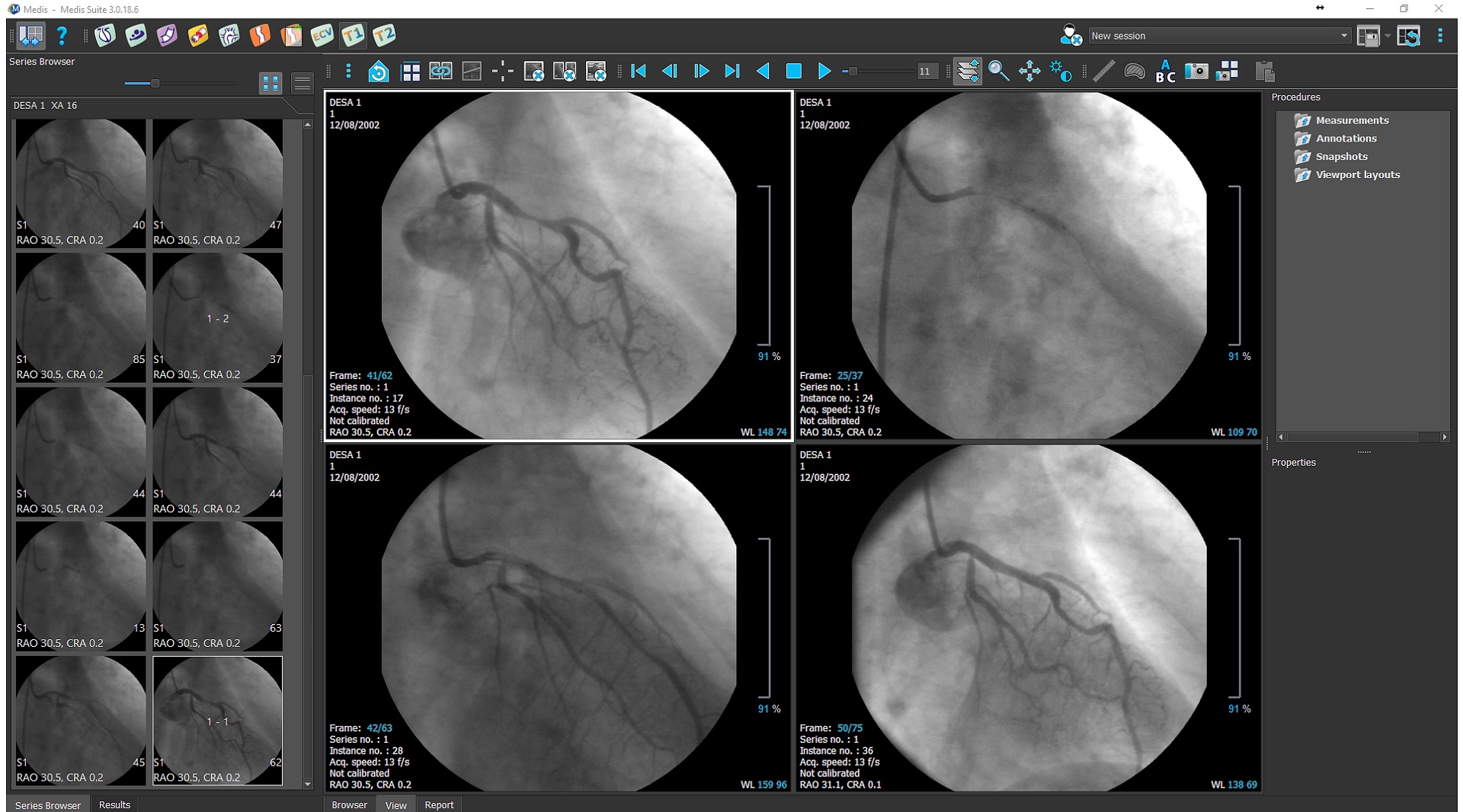 Medis Stenting